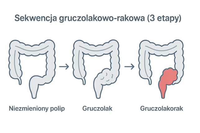 gruczolak-sekwencja